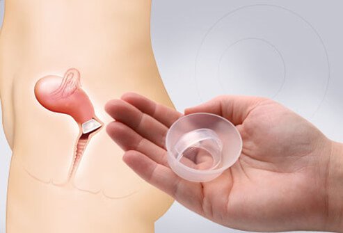 A birth control device, a cervical cap, and diagram on how it is used.