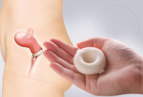 The Today Sponge is a small, doughnut-shaped, foam sponge saturated with spermicide.