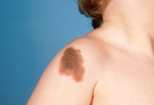 Congenital melanocytic nevi are abnormal accumulations of pigment-producing cells in the deeper layers of the skin.