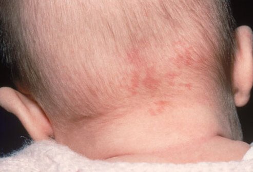 The medical term for this most common of birthmarks is capillary nevus simplex (commonly called stork bites). 