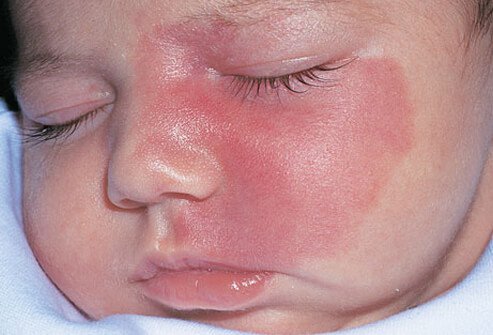Port-wine stains refer to the purplish-red color of these vascular malformations.