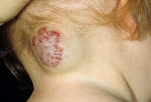 The distinction between capillary and cavernous hemangiomas depends on the caliber of the vessels composing the majority of the tumor.