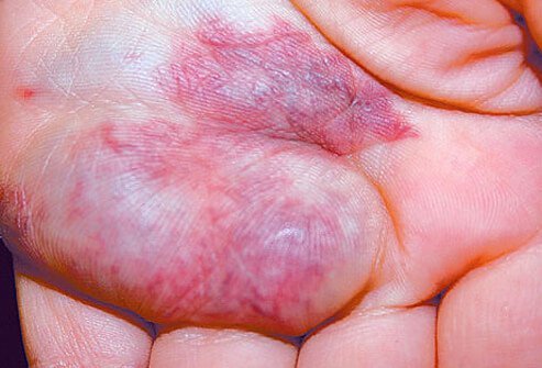 Venous malformations are masses of nonproliferating venous structures, which may occur anywhere in the body or on the skin.