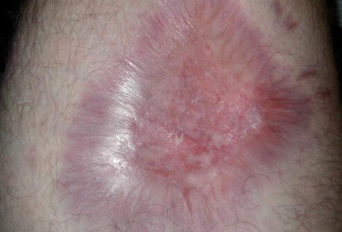 Example of a brown recluse spider bite 10 months after the bite.