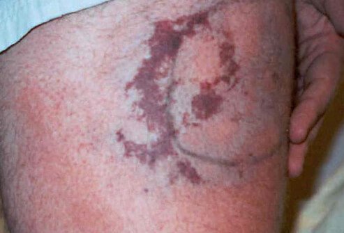A brown recluse spider bite may appear slightly red and when you look closely you may see fang marks.
