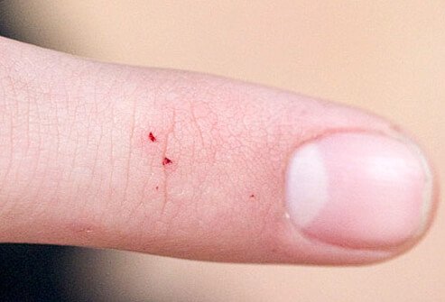 The initial bite of a black widow spider may only show a minimal local reaction.
