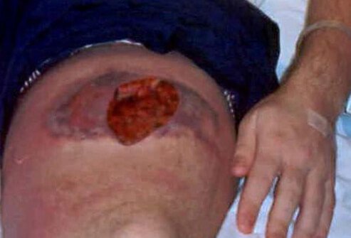 In severe cases, the reaction to a brown recluse spider bite can lead to death of the skin (necrosis) and subcutaneous fat.