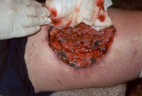 As the reaction to the brown recluse spider bite progresses, severe necrotic lesions with deep, wide borders can result.