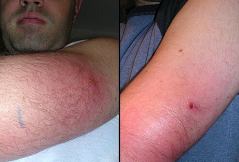 Example of a back widow spider bite several hours (left) to several days later (right).