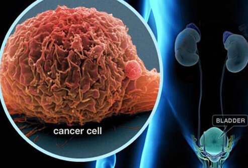 Picture of Bladder Cancer