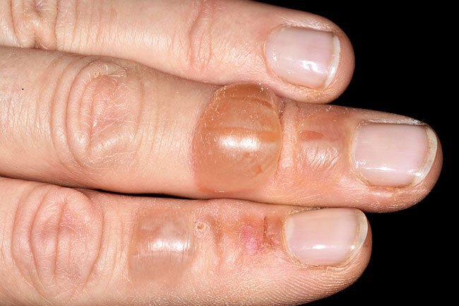 Blisters are fluid filled circular pockets of skin. 