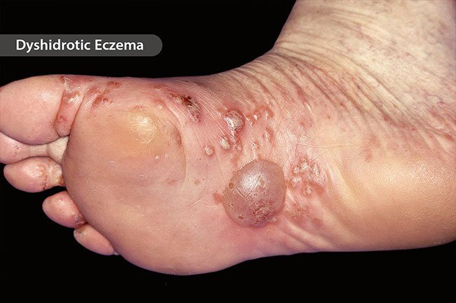 Sometimes, very itchy blisters appear on your palms or the soles of your feet as a result of atopic dermatitis or eczema.
