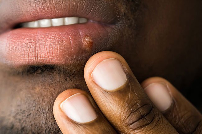Blisters on the lips, mouth, or genitals may be due to the herpes simplex virus.