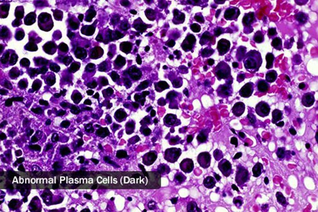 Myeloma is a cancer in the white blood cells called plasma cells.
