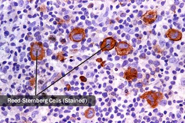 Reed-Sternberg cells are found in a subtype of Hodgkin’s lymphoma.