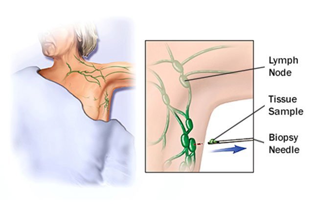 Blood cancer symptoms may include night sweats, swollen lymph nodes, and other symptoms.
