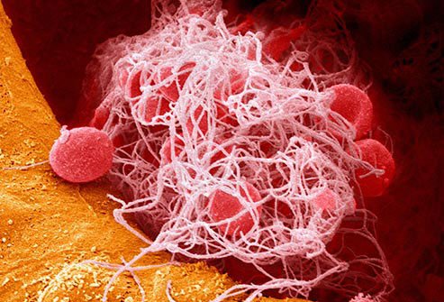 It’s a clump of cells and protein in your blood.
