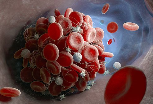 A thrombus is a blood clot that occurs in and occludes a vein while a blood clot forms within an artery or vein and it can break off and travel to the heart or lungs, causing a medical emergency. 