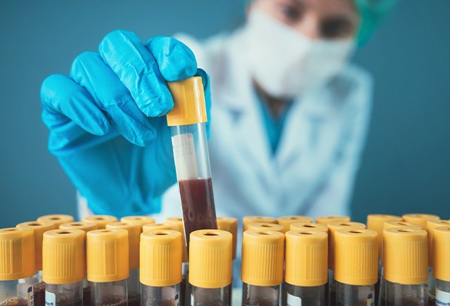 Ulcerative colitis is a condition that causes blood stool, diarrhea, rectal pain and other symptoms. Ulcerative colitis is diagnosed with blood tests, stool tests and imaging tests.