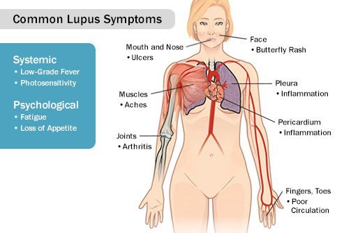 Lupus can cause your joints and tendons to swell, causing pain.