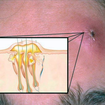An illustration callout of a furuncle or carbuncle on a person's forehead.
