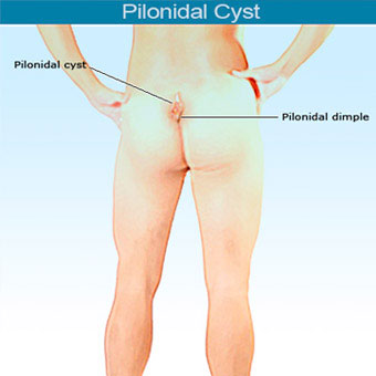 An illustration of a pilonidal cyst that occurs in or above the crease of the buttocks.