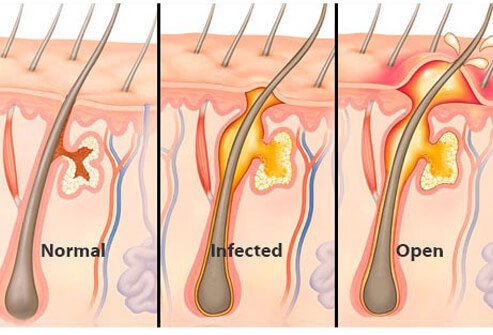 A boil, also referred to as a skin abscess, is a localized infection deep in the skin.