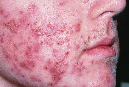 Picture of Cystic Acne