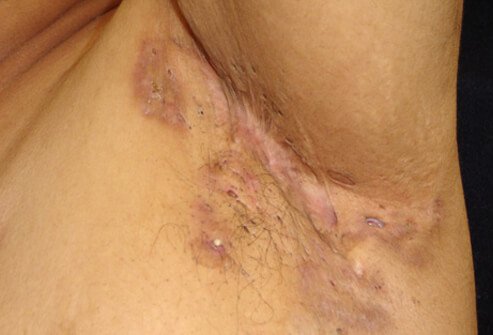 Picture of Hidradenitis Suppurativa