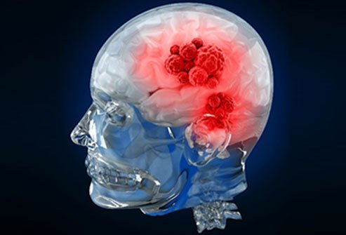 Brain tumors occur from a variety of cell types in different locations in the brain.