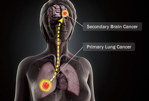 Secondary brain cancer starts elsewhere and spreads to the brain.