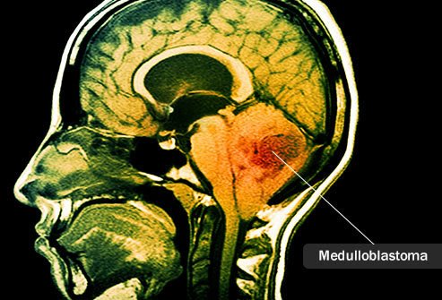 Medulloblastoma is a primary brain tumor in the back of the brain.