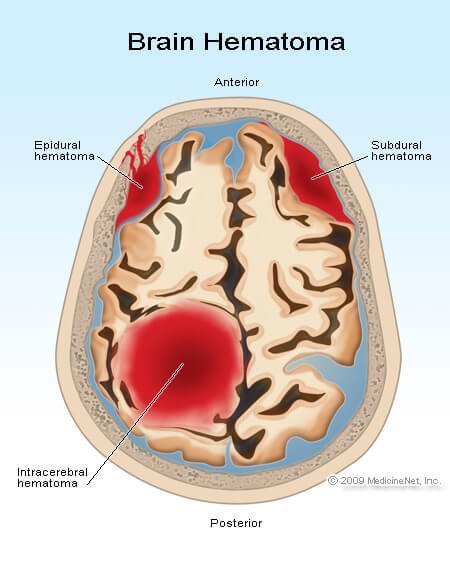 Picture of an epidural, subdural, and intracerebral hematomas