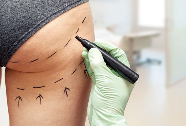 A Brazilian butt lift is a cosmetic procedure that involves the transfer of fat from one part of the body to the buttocks