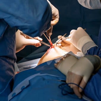 There are two types of surgery for removing breast cancer: breast-conserving surgery and mastectomy.