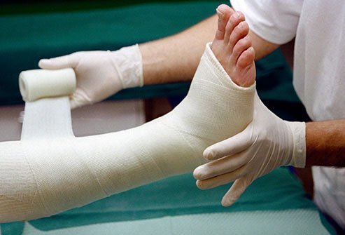 A cast immobilizes a bone while it heals after a fracture.