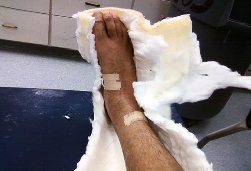 An injured area may appear smaller and hairier after a cast is removed.