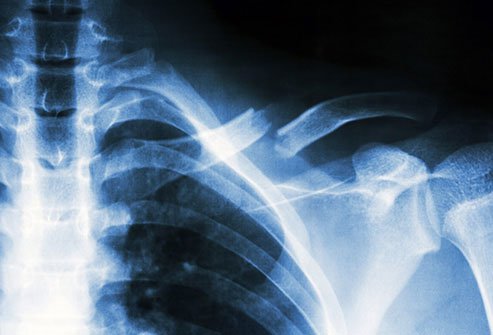 There are several different types of bone fractures.