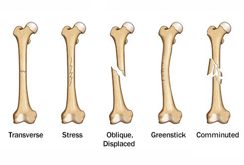 There are several different types of bone fractures.