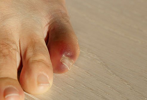 Pain, swelling, and bruising are a few symptoms of bone fractures.
