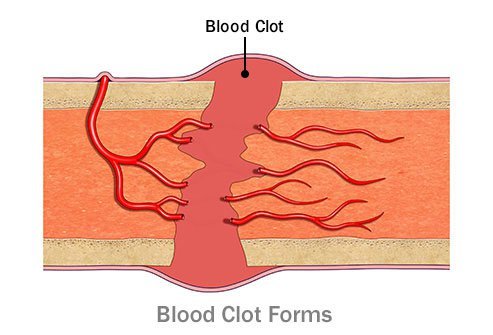 In the initial healing phase, a blood clot initially forms at the fracture site.