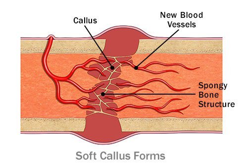A soft callus gradually replaces the blood clot.