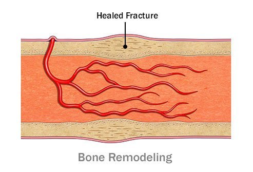 Bone remodeling results in new bone formation.