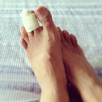 A person with the buddy tape treatment for his broken toe.