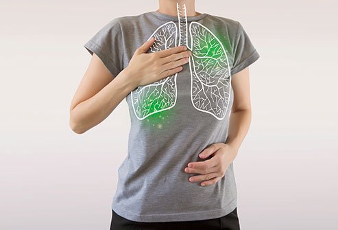 Bronchiectasis is a chronic lung condition in which the bronchi (tube-like passageways that transfer air within the lungs) get permanently damaged and widened. The most common causes of bronchiectasis are pneumonia, pertussis, tuberculosis and non-tuberculosis mycobacterium.