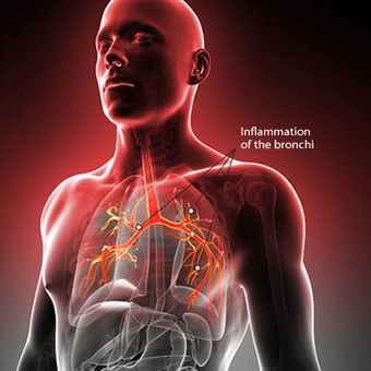 Illustration of bronchitis.