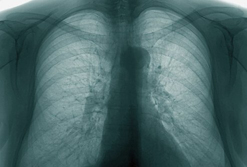 Bronchitis is an inflammation of the airways in the lungs.