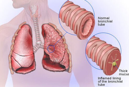 Acute bronchitis is a form of the illness that starts suddenly and resolves itself after just a few weeks.