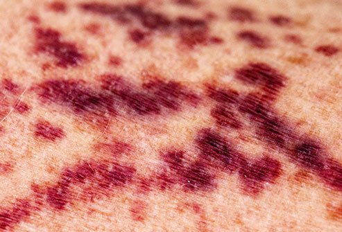 Purpura are red or purple spots under the skin that resemble bruises.