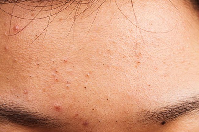 Side effects of corticosteroids include weight gain, puffy face, nausea, mood swings, trouble sleeping, thinner skin, acne, unusual hair growth, and spikes in blood sugar and blood pressure.